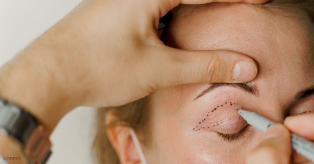 Doctor putting lines on woman's eyelids (models) to prep her for eyelid surgery.